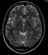 MRIスキャン画像1